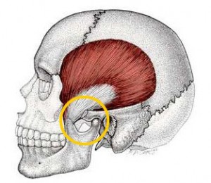 Illustration of TMJ disorder